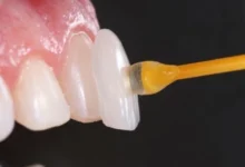 دلایل افتادن لمینت دندان چیست و چگونه می‌توان از آن جلوگیری کرد؟
