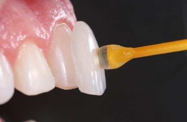 دلایل افتادن لمینت دندان چیست و چگونه می‌توان از آن جلوگیری کرد؟