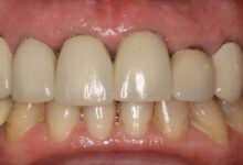 آیا لمینت دندان و پوسیدگی دندان با هم مرتبط هستند؟